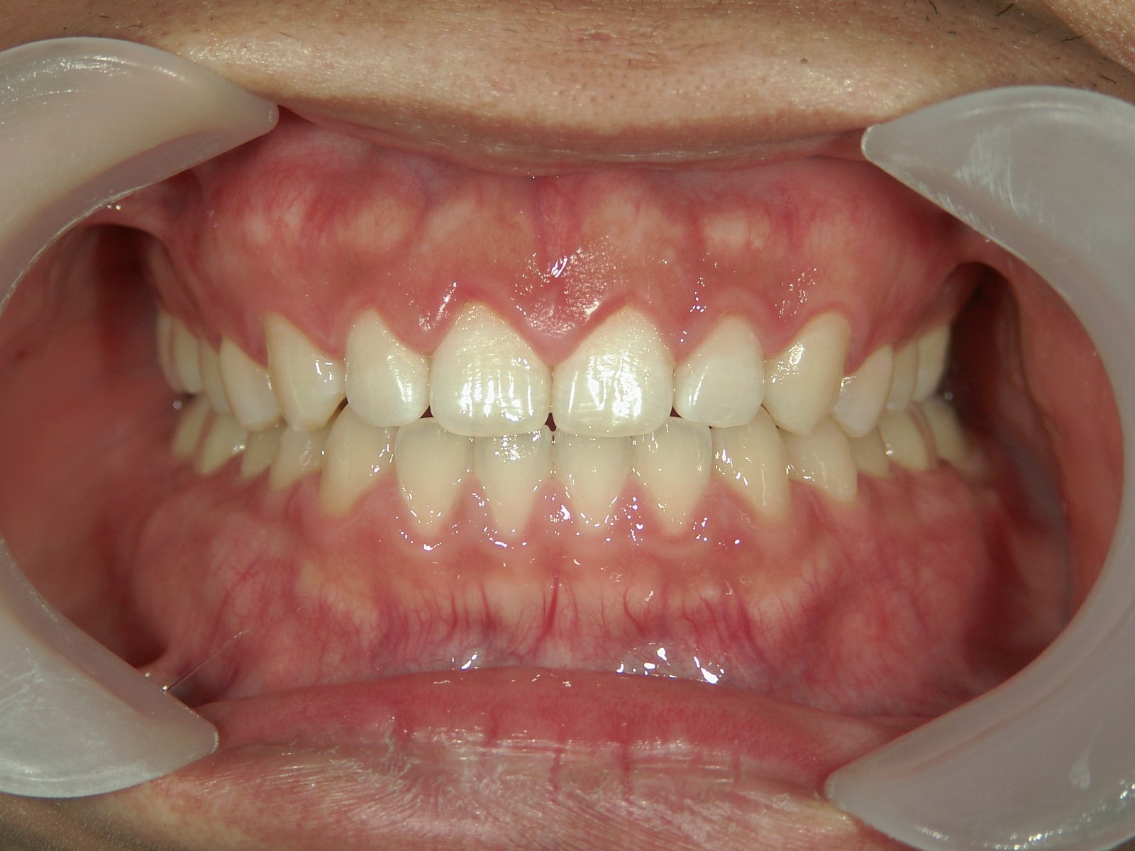 舌側ワイヤー矯正　症例（17）