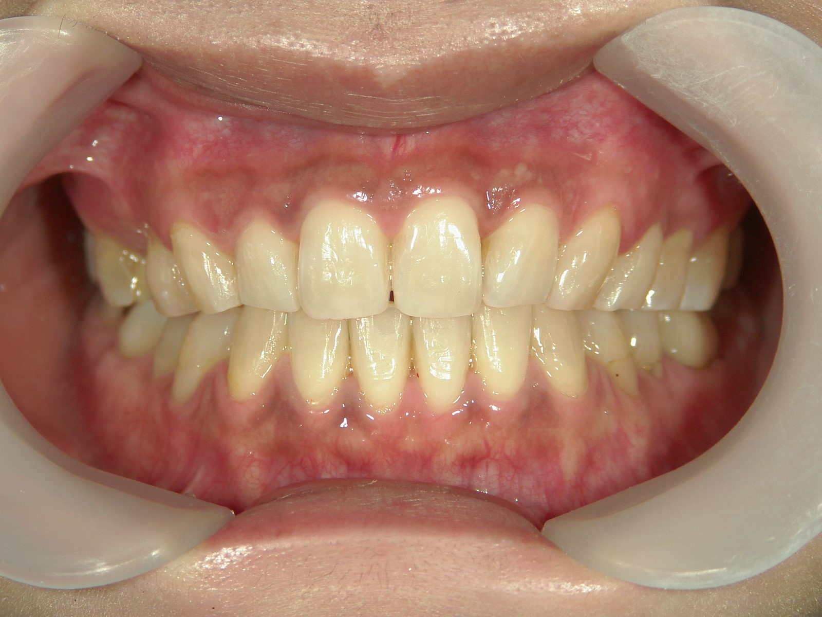 プチ舌側ワイヤー矯正　症例（18）