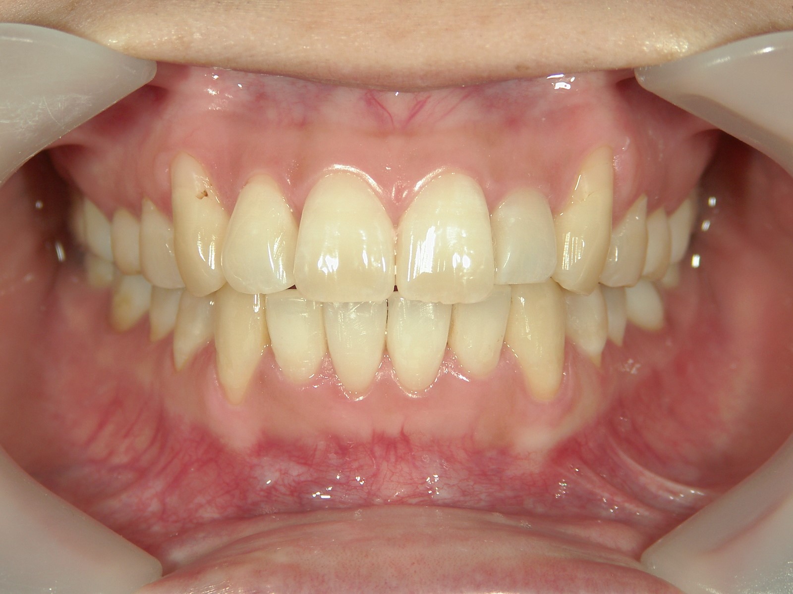 プチ舌側ワイヤー矯正　症例（19）