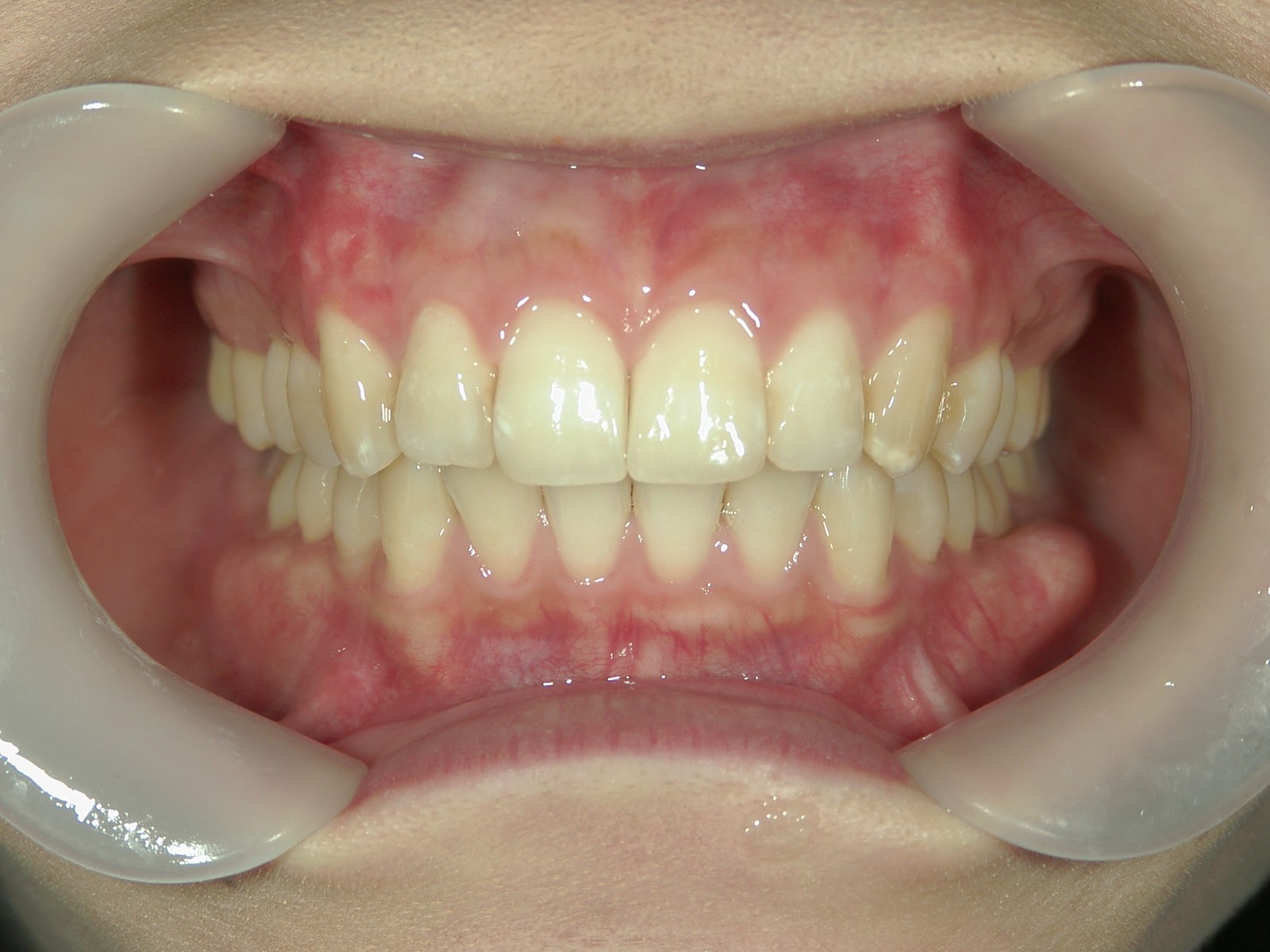 プチ舌側ワイヤー矯正　症例（24）