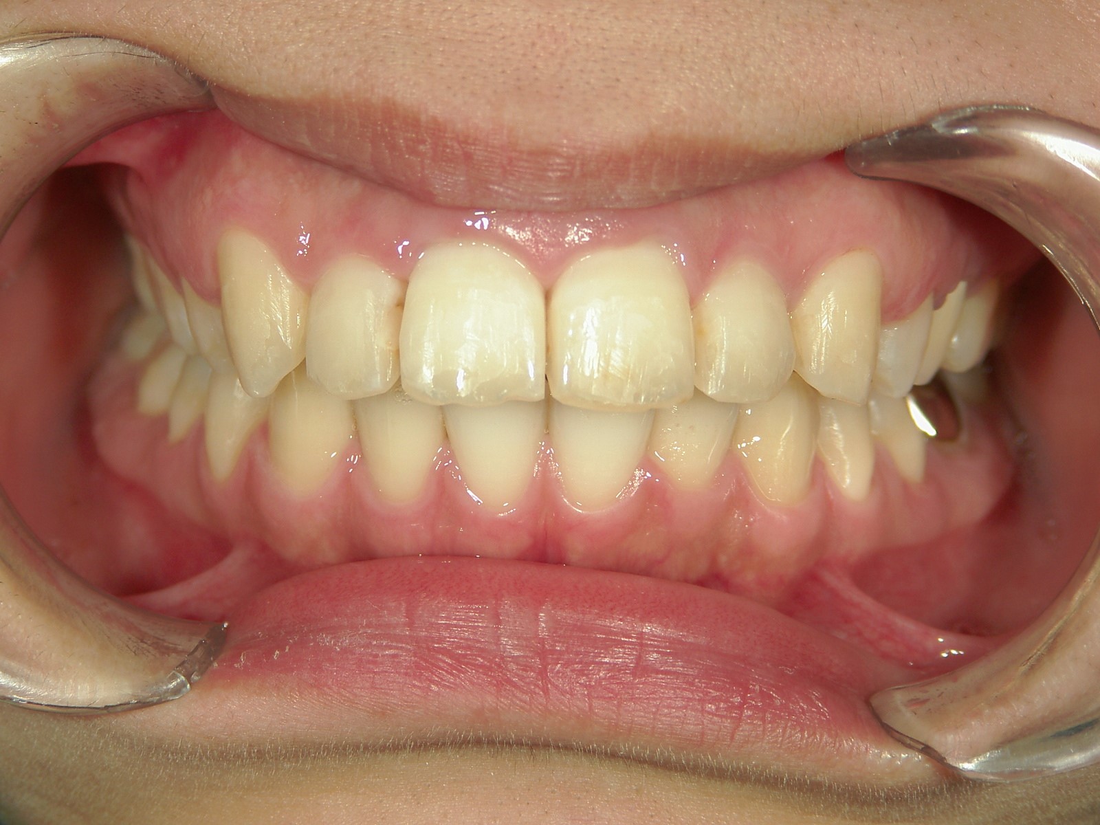 プチワイヤー矯正　症例（27）