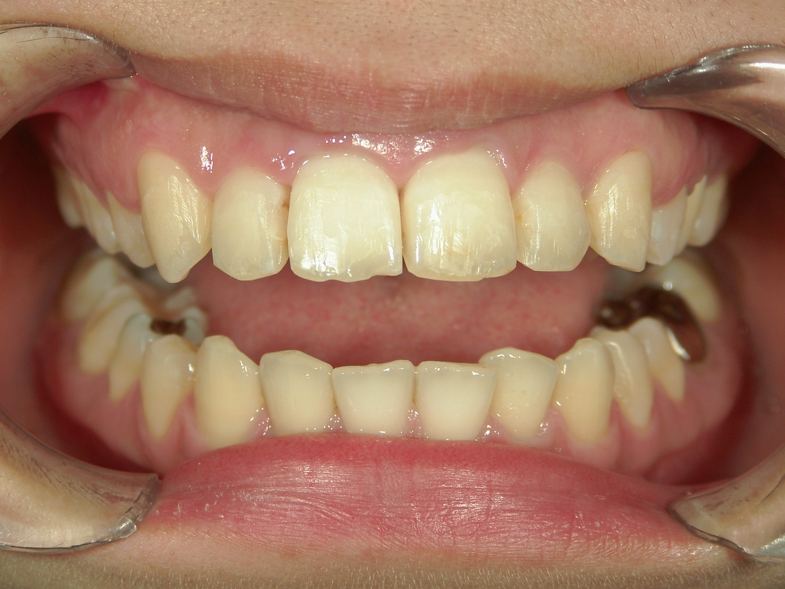 プチワイヤー矯正　症例（27）