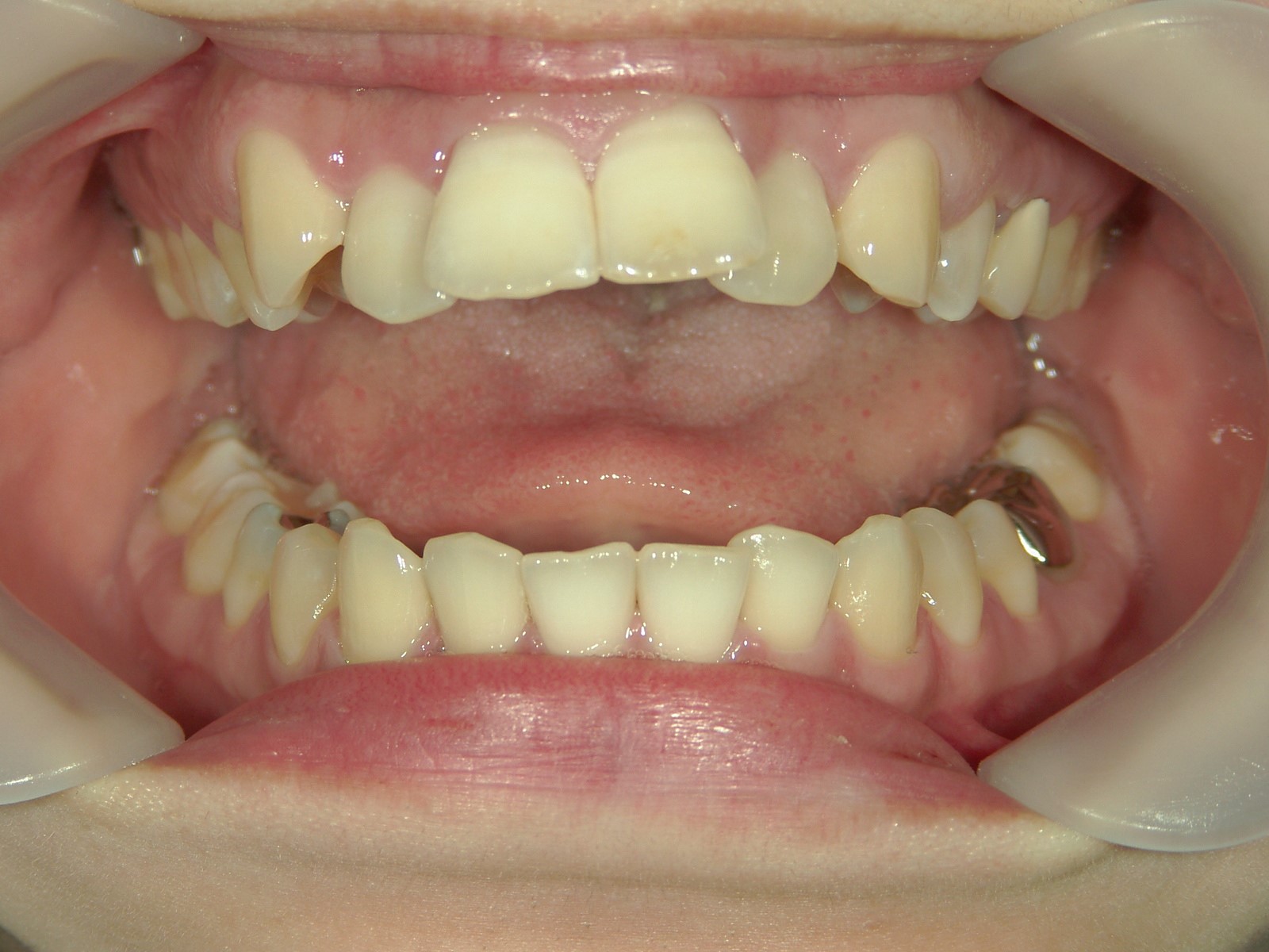 プチワイヤー矯正　症例（27）