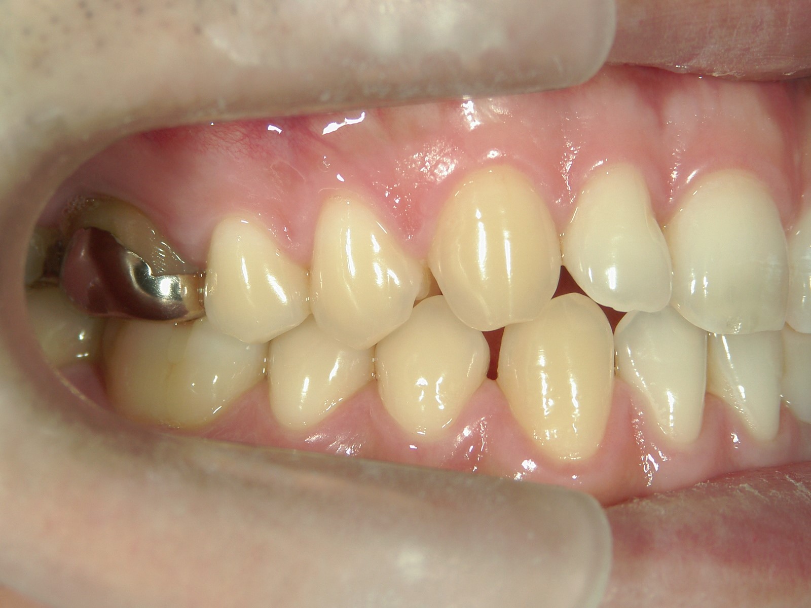 プチ舌側ワイヤー矯正　症例（10）