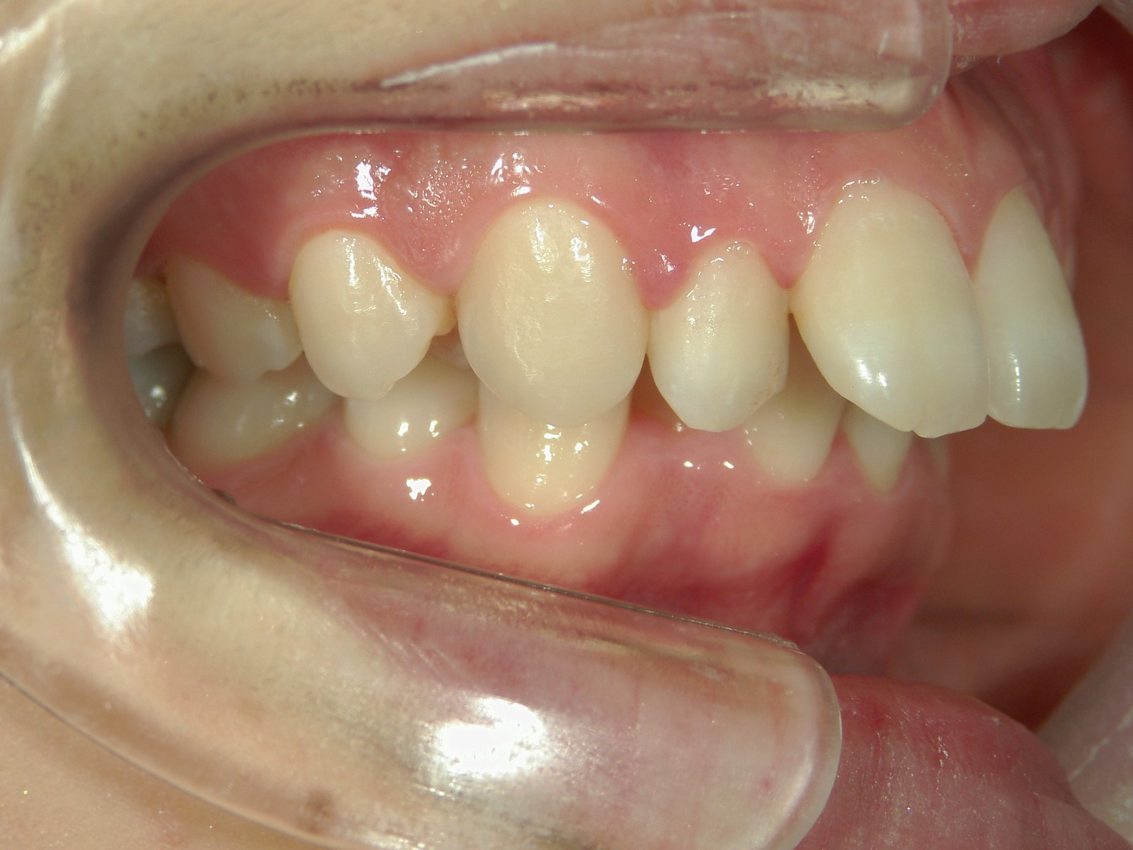 舌側ワイヤー矯正　症例（14）