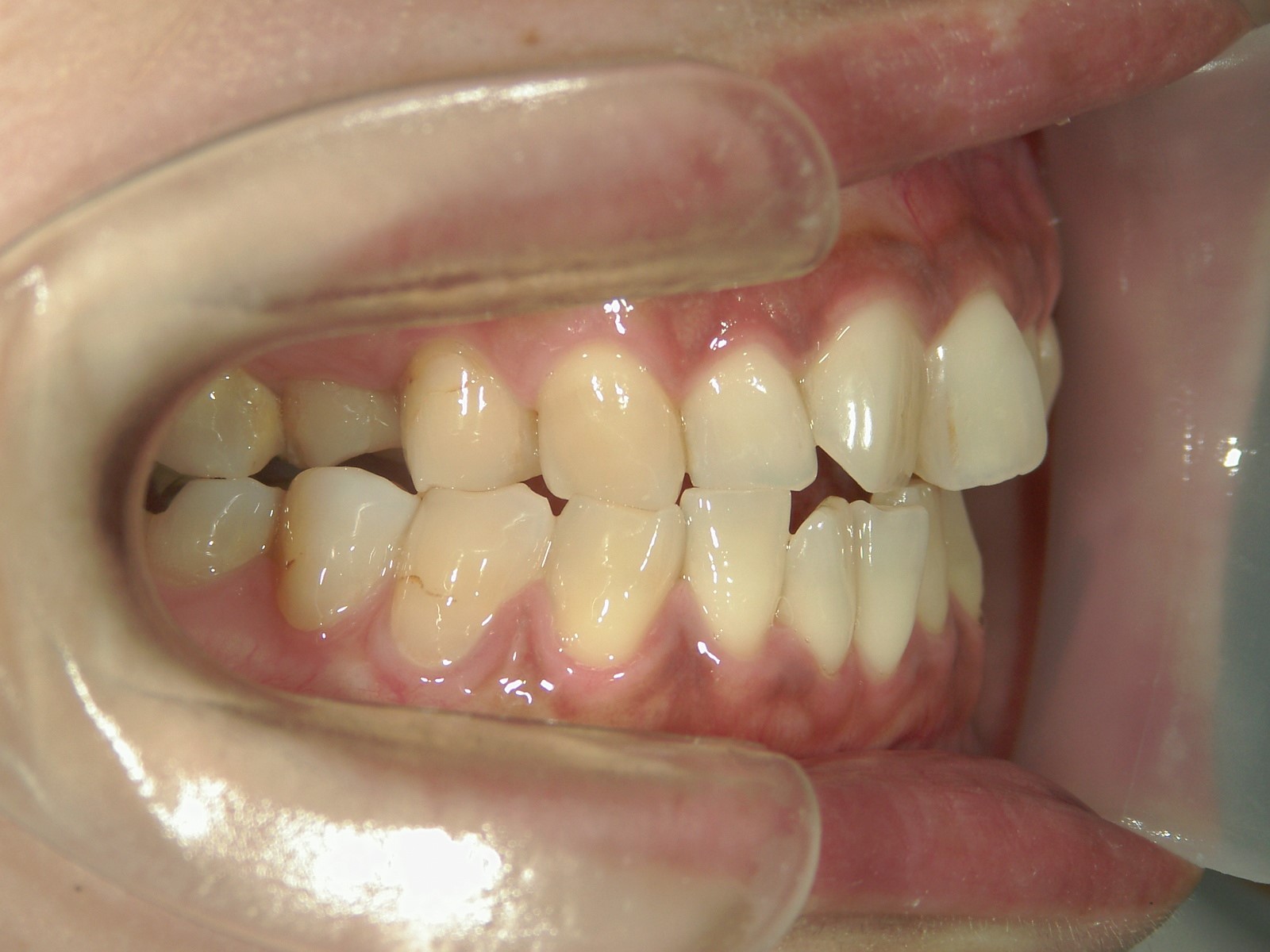 プチ舌側ワイヤー矯正　症例（18）