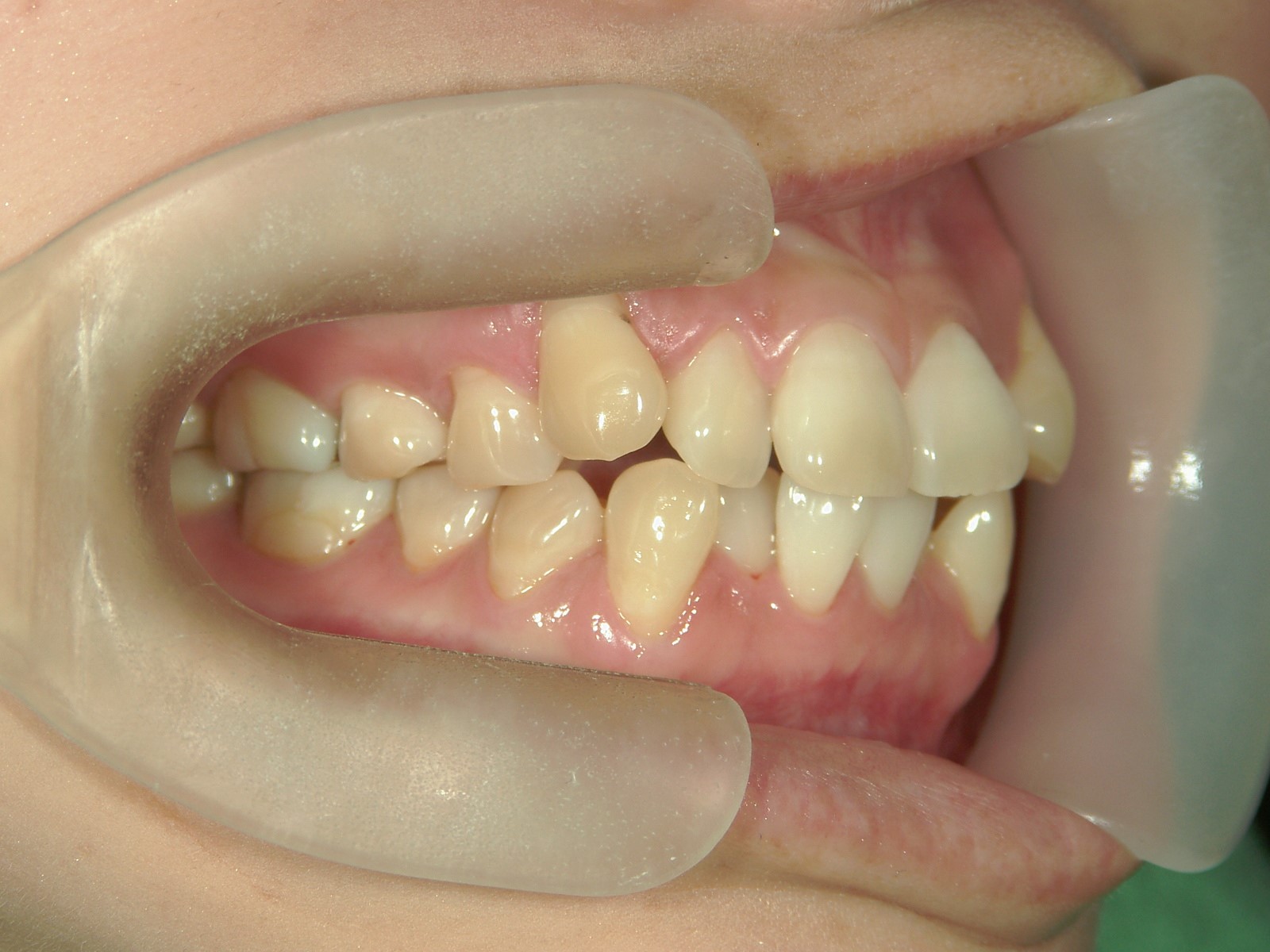 プチ舌側ワイヤー矯正　症例（19）