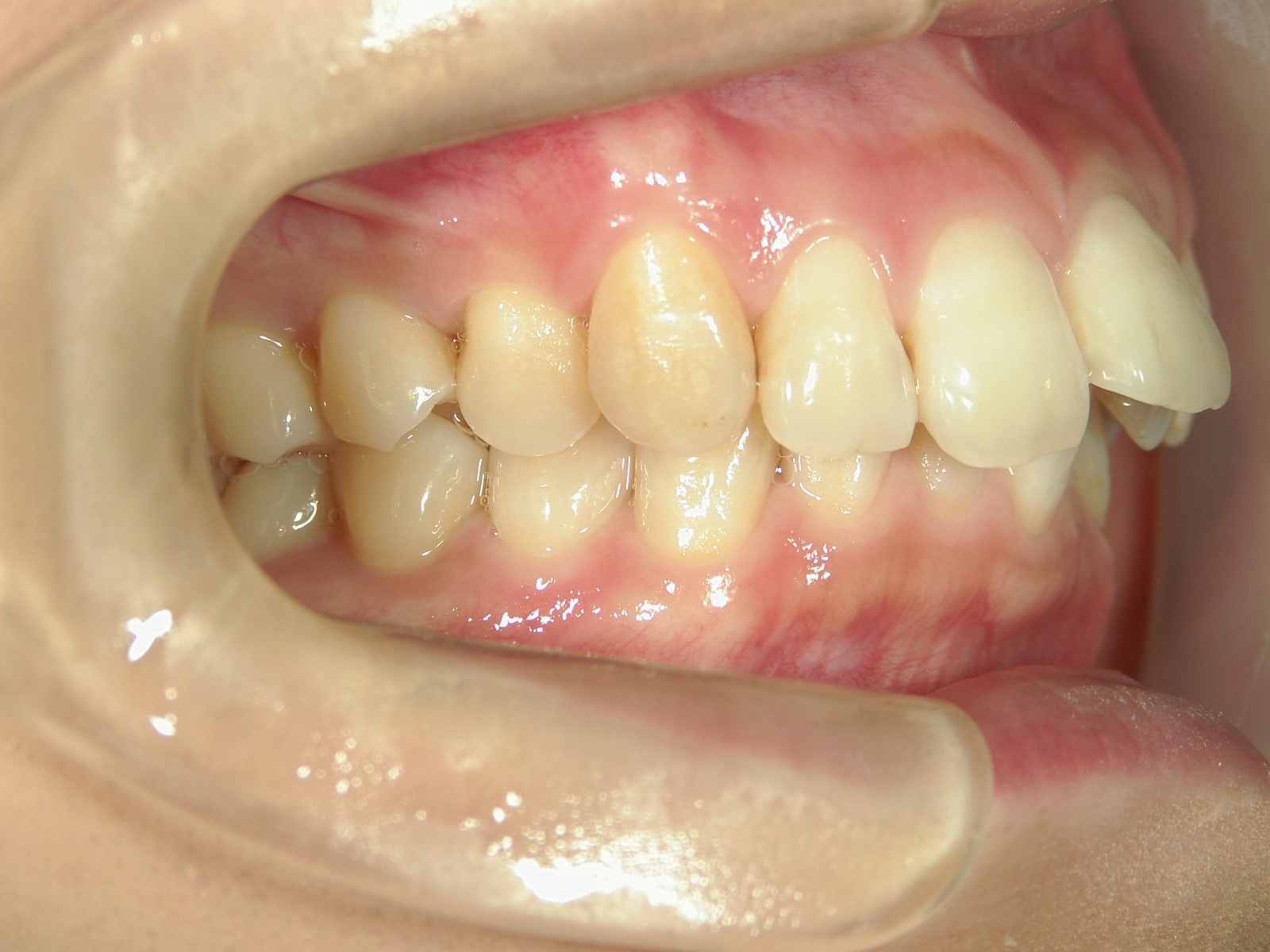 プチ舌側ワイヤー矯正　症例（24）