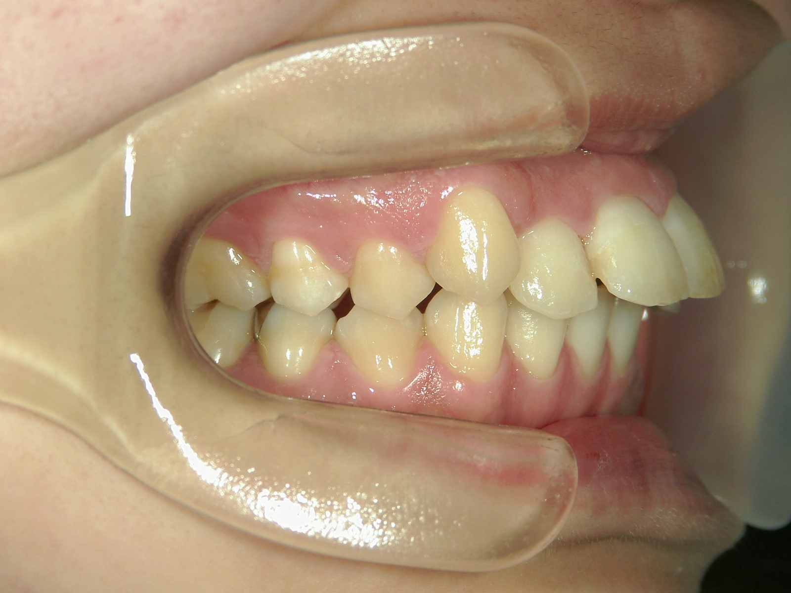 プチワイヤー矯正　症例（27）