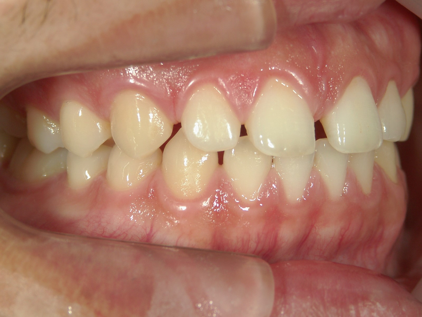 舌側ワイヤー矯正　症例（17）