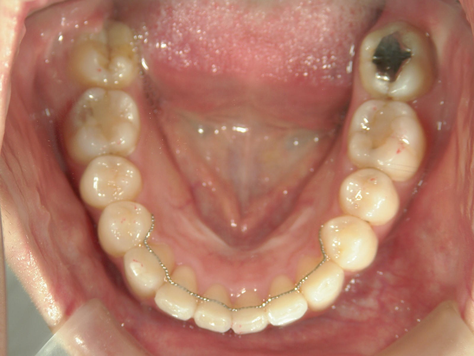 舌側ワイヤー矯正　症例（14）