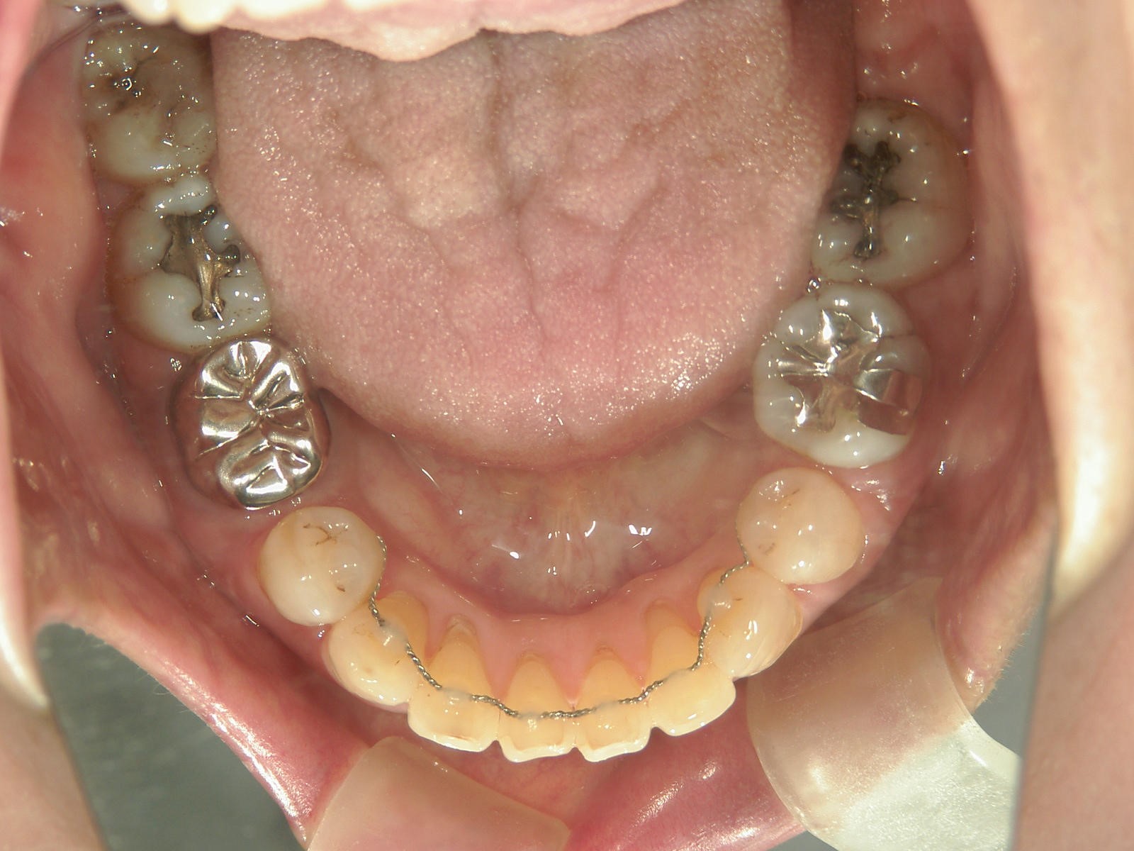舌側ワイヤー矯正　症例（15）