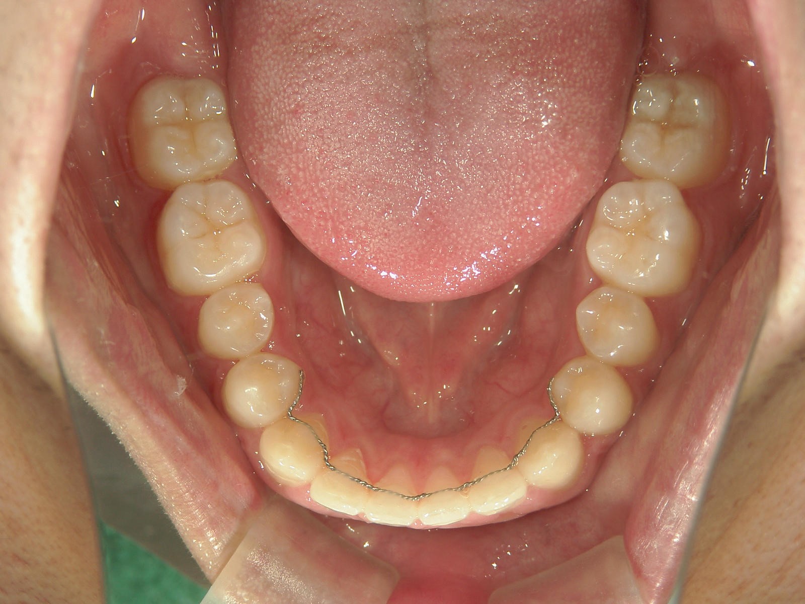 舌側ワイヤー矯正　症例（17）