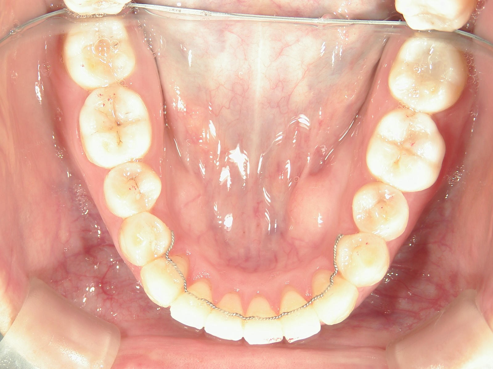 プチ舌側ワイヤー矯正　症例（19）