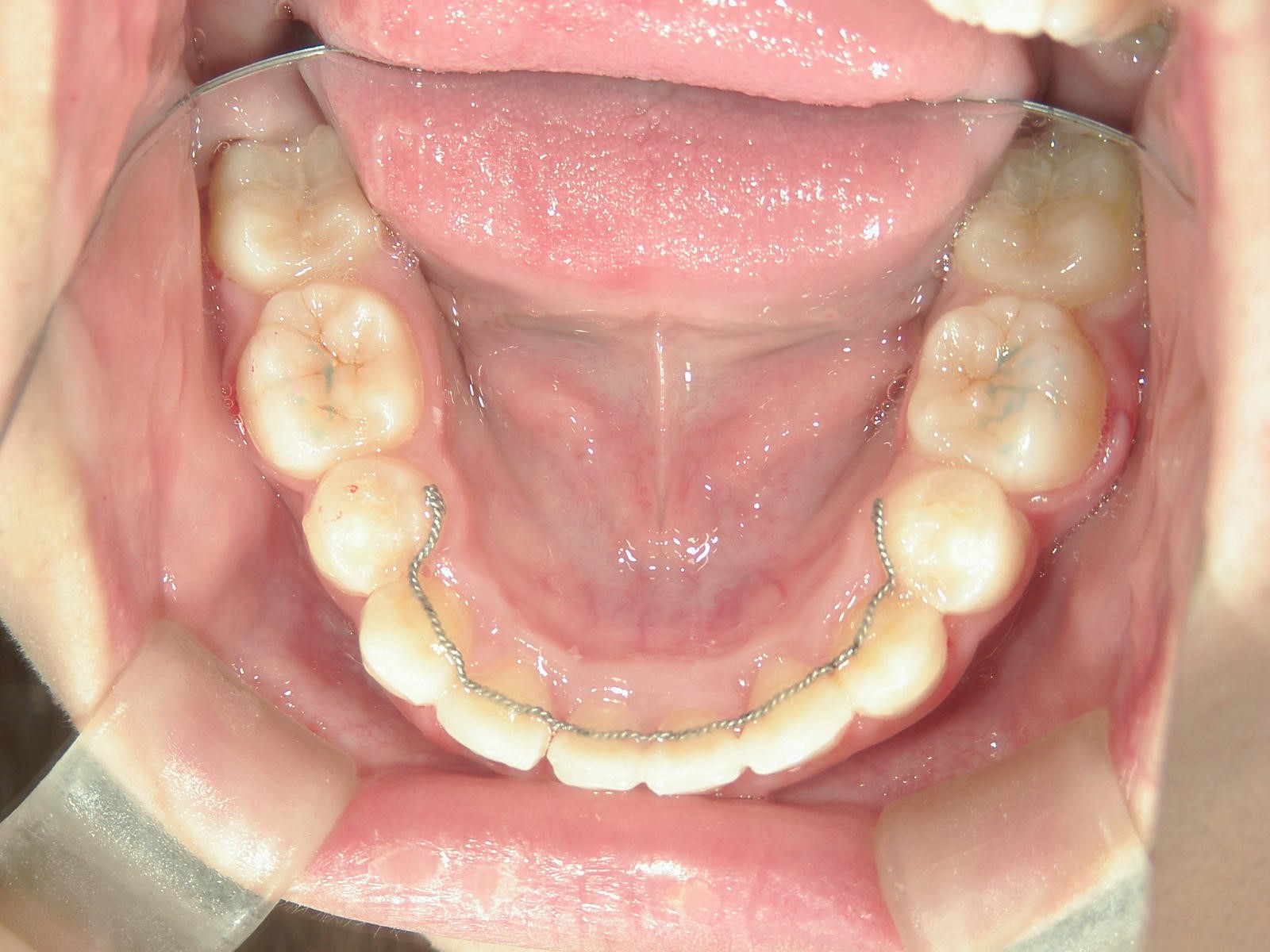 舌側ワイヤー矯正　症例（21）