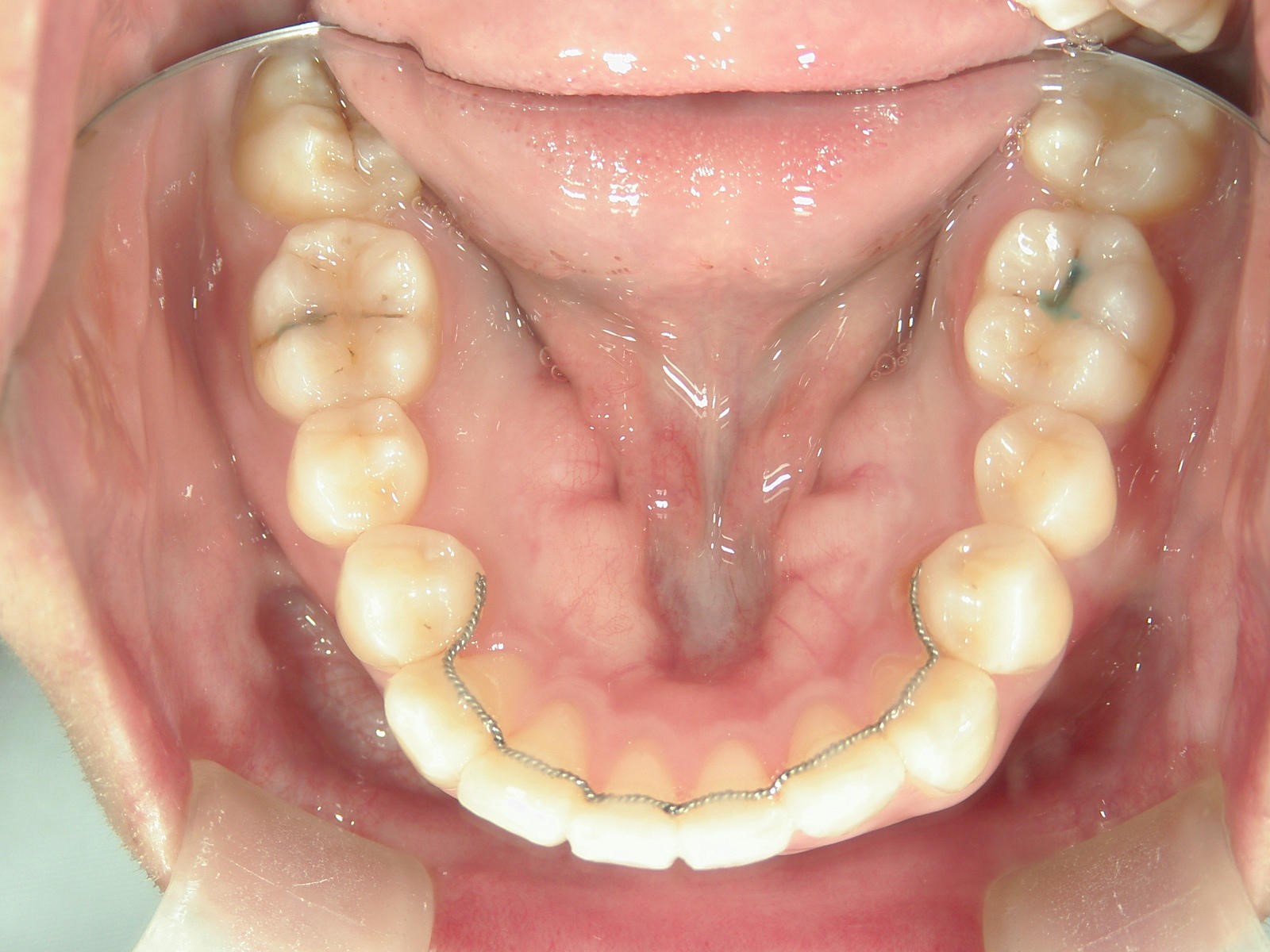 プチ舌側ワイヤー矯正　症例（24）