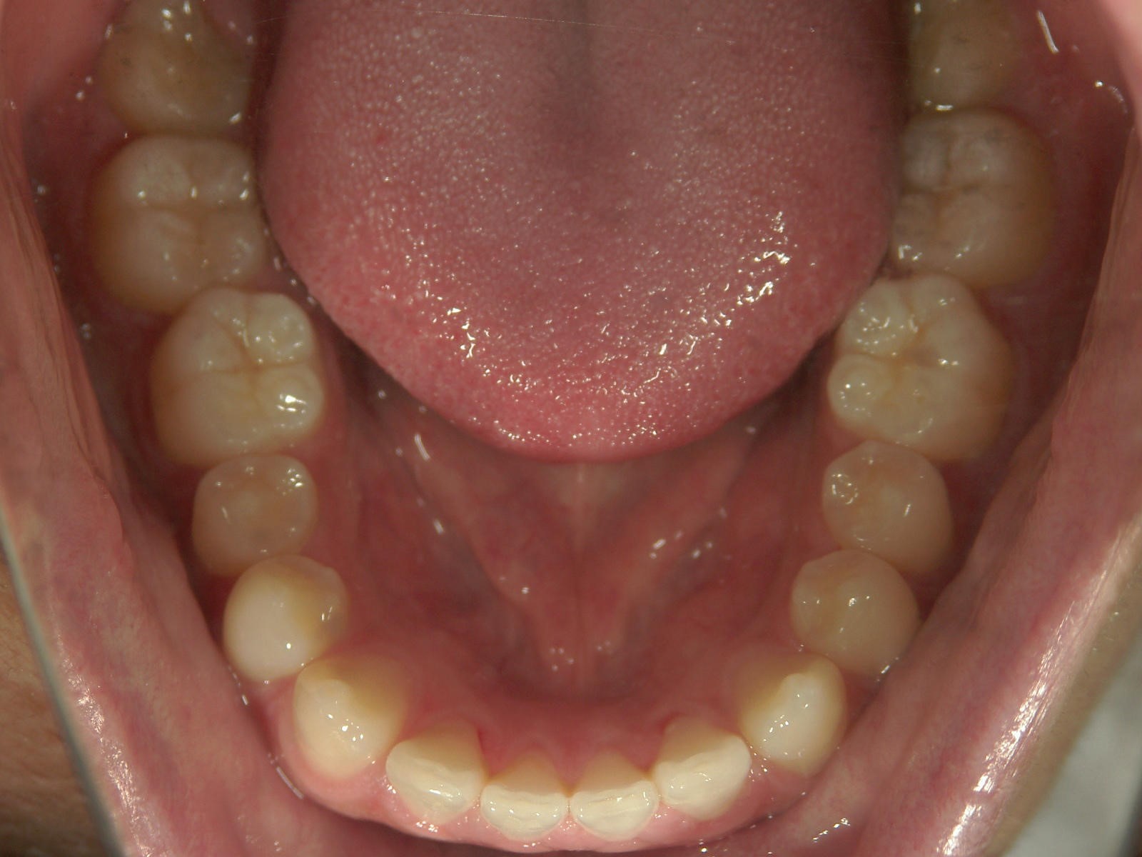 舌側ワイヤー矯正　症例（17）