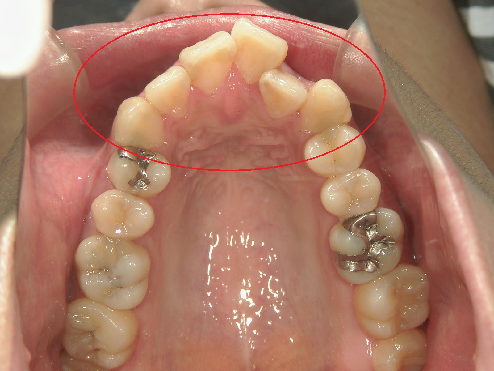 プチ舌側ワイヤー矯正　症例（20）