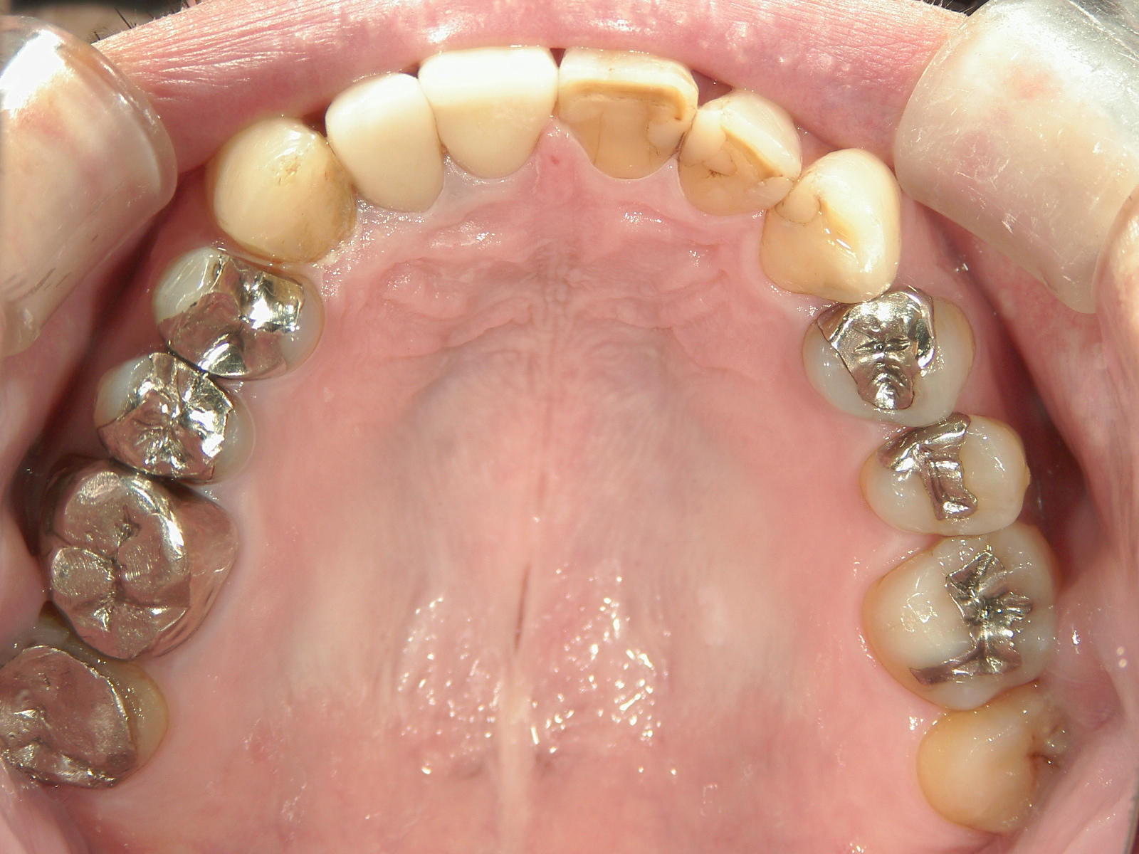 補綴併用症例（1）