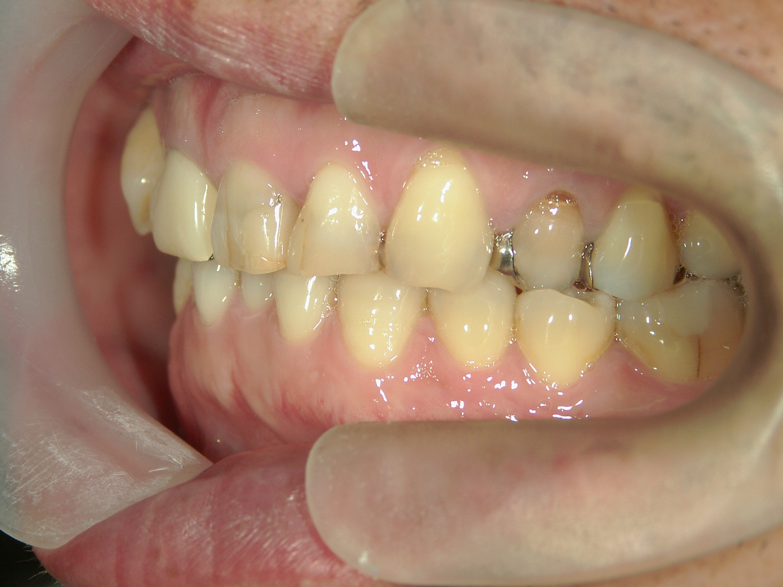 補綴併用症例（1）