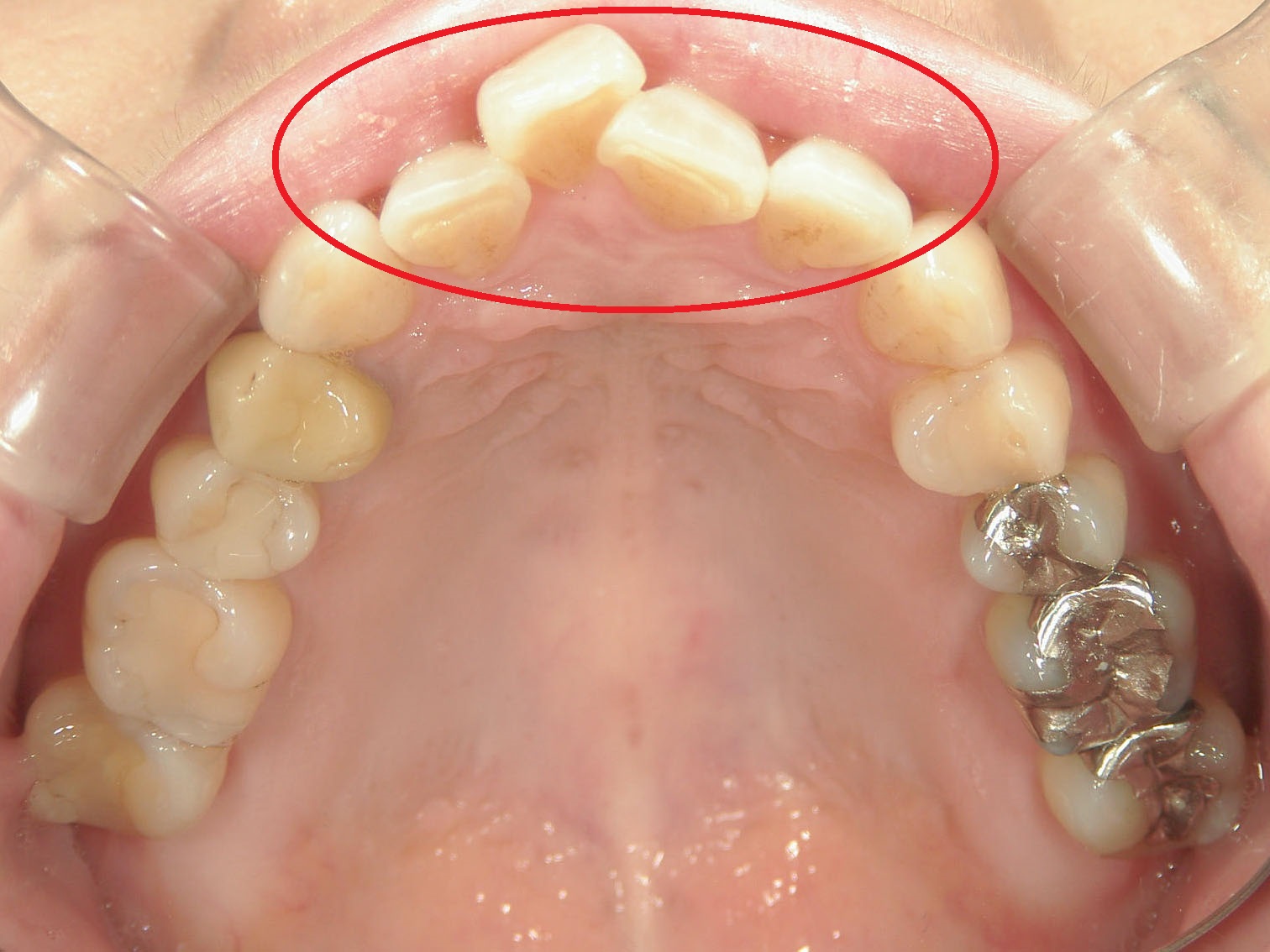 ワンポイント矯正　症例（2）