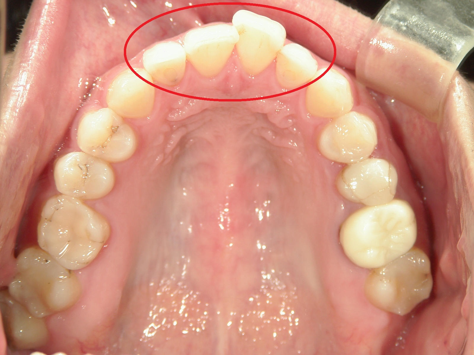 ワンポイント矯正　症例（4）