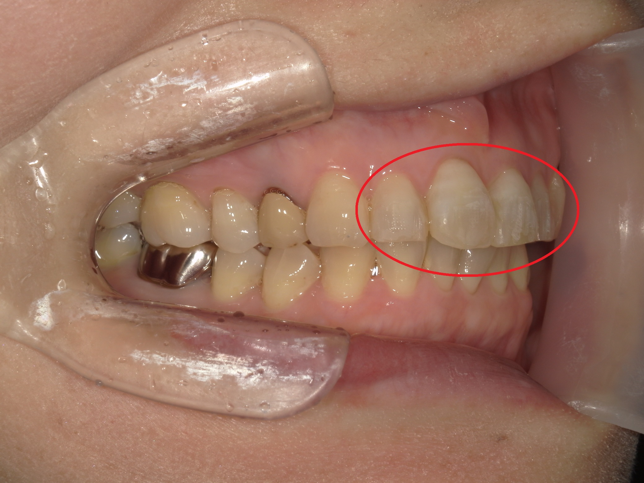 ワンポイント矯正　症例（2）