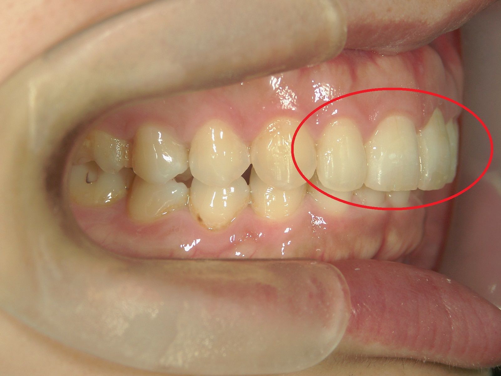 ワンポイント矯正　症例（4）