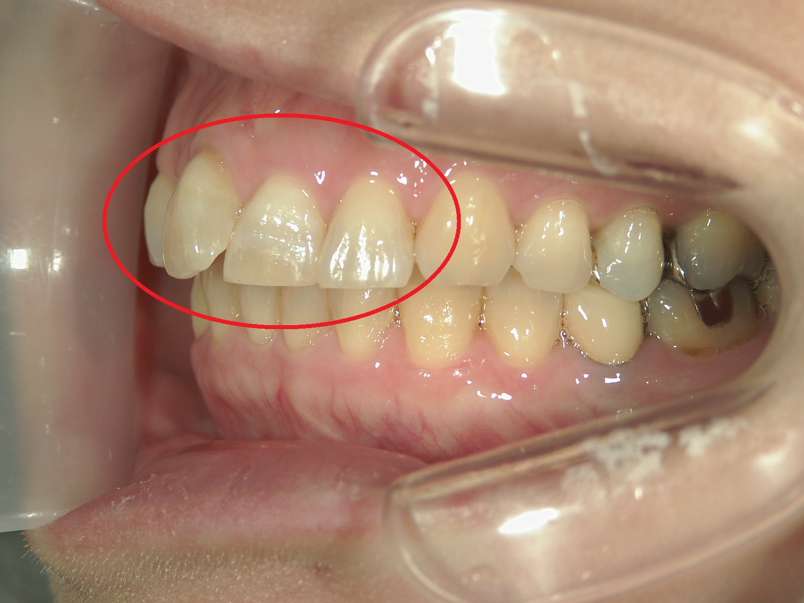ワンポイント矯正　症例（2）