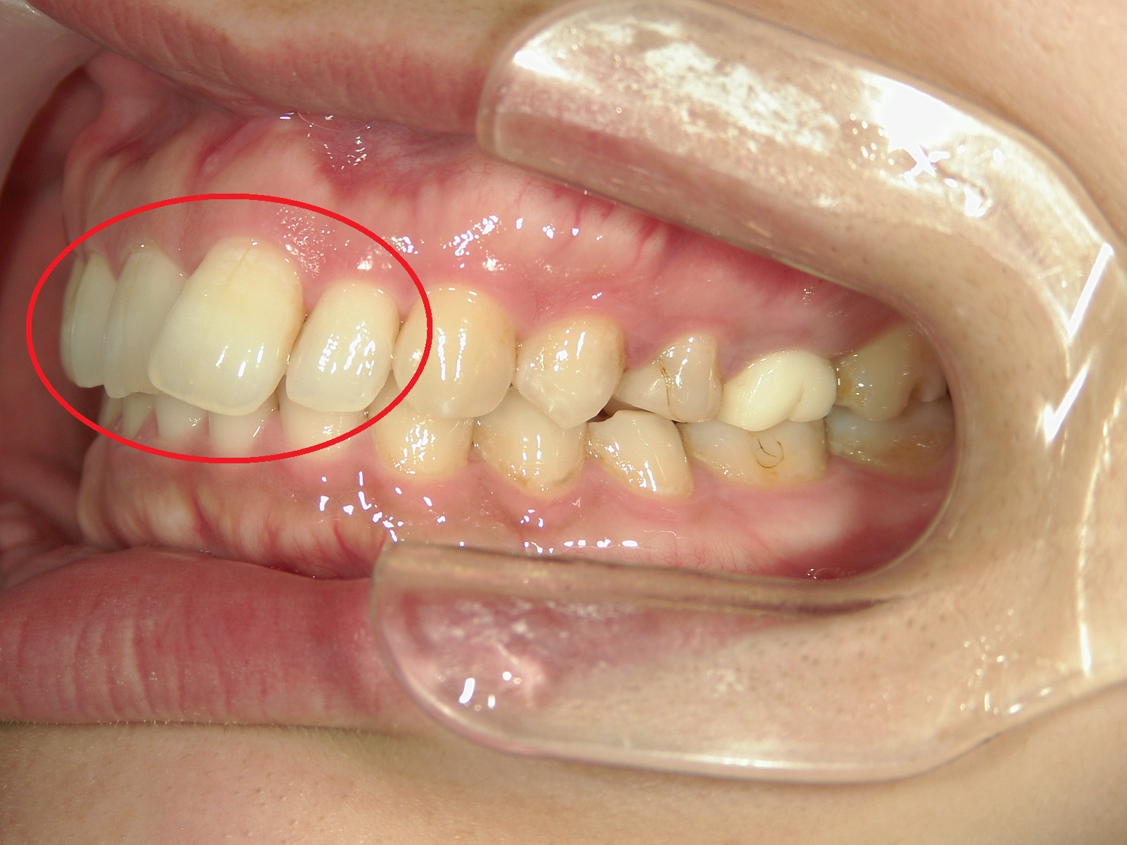 ワンポイント矯正　症例（4）