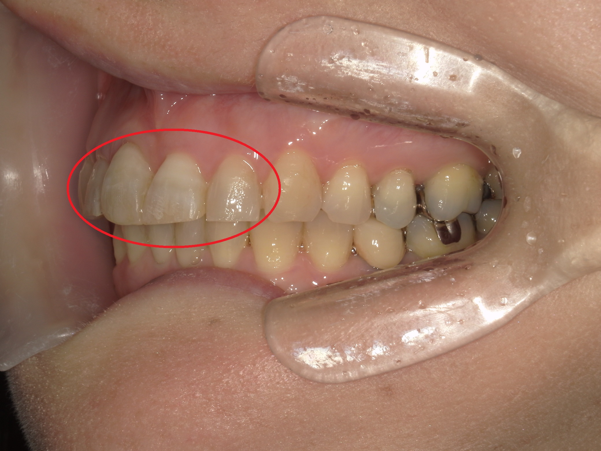 ワンポイント矯正　症例（2）