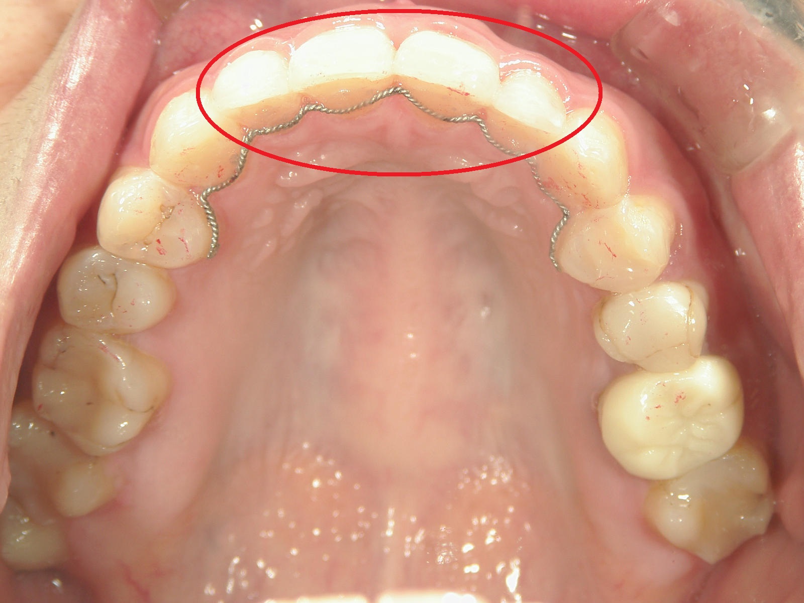 ワンポイント矯正　症例（4）