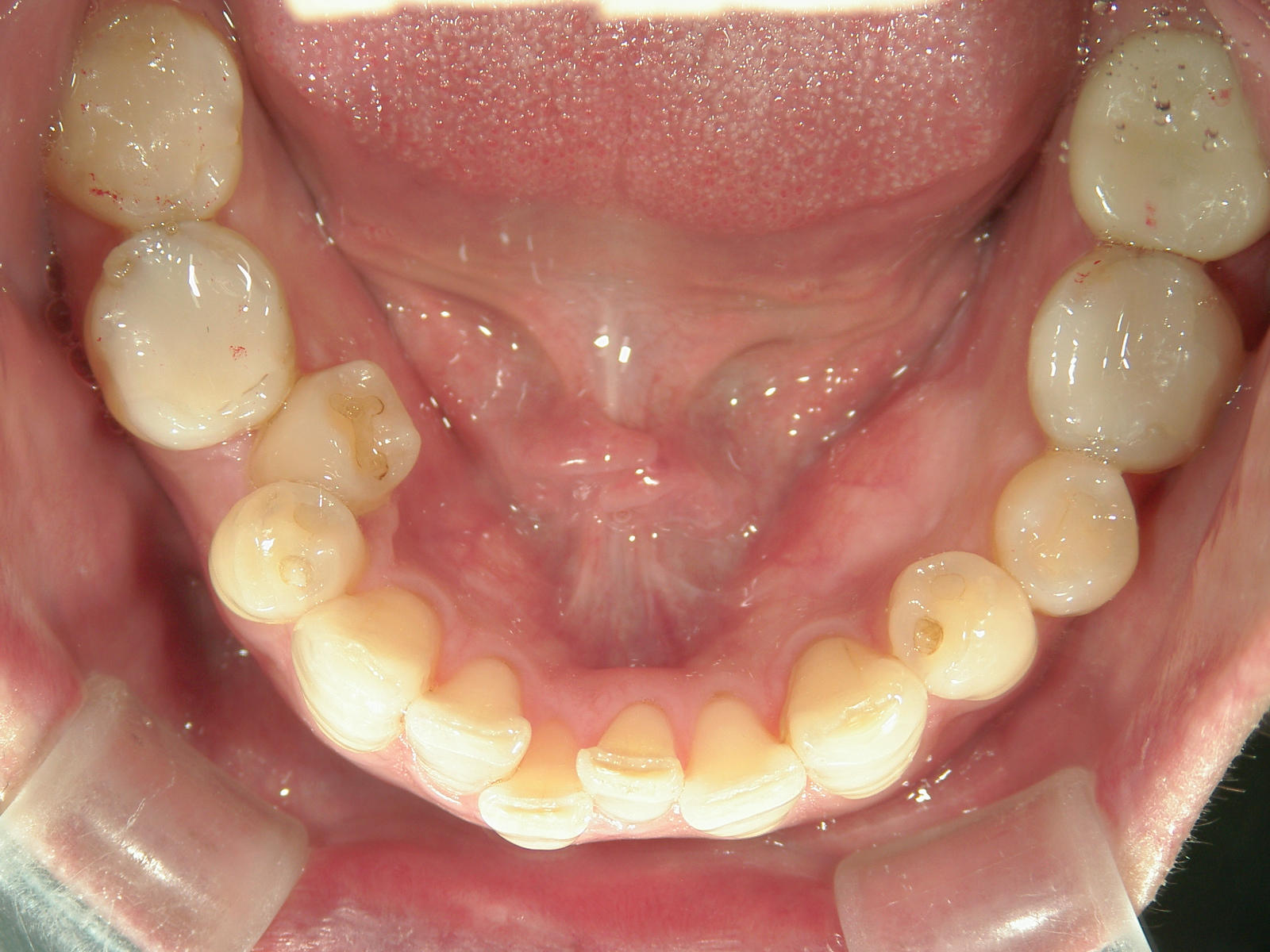 補綴併用症例（1）