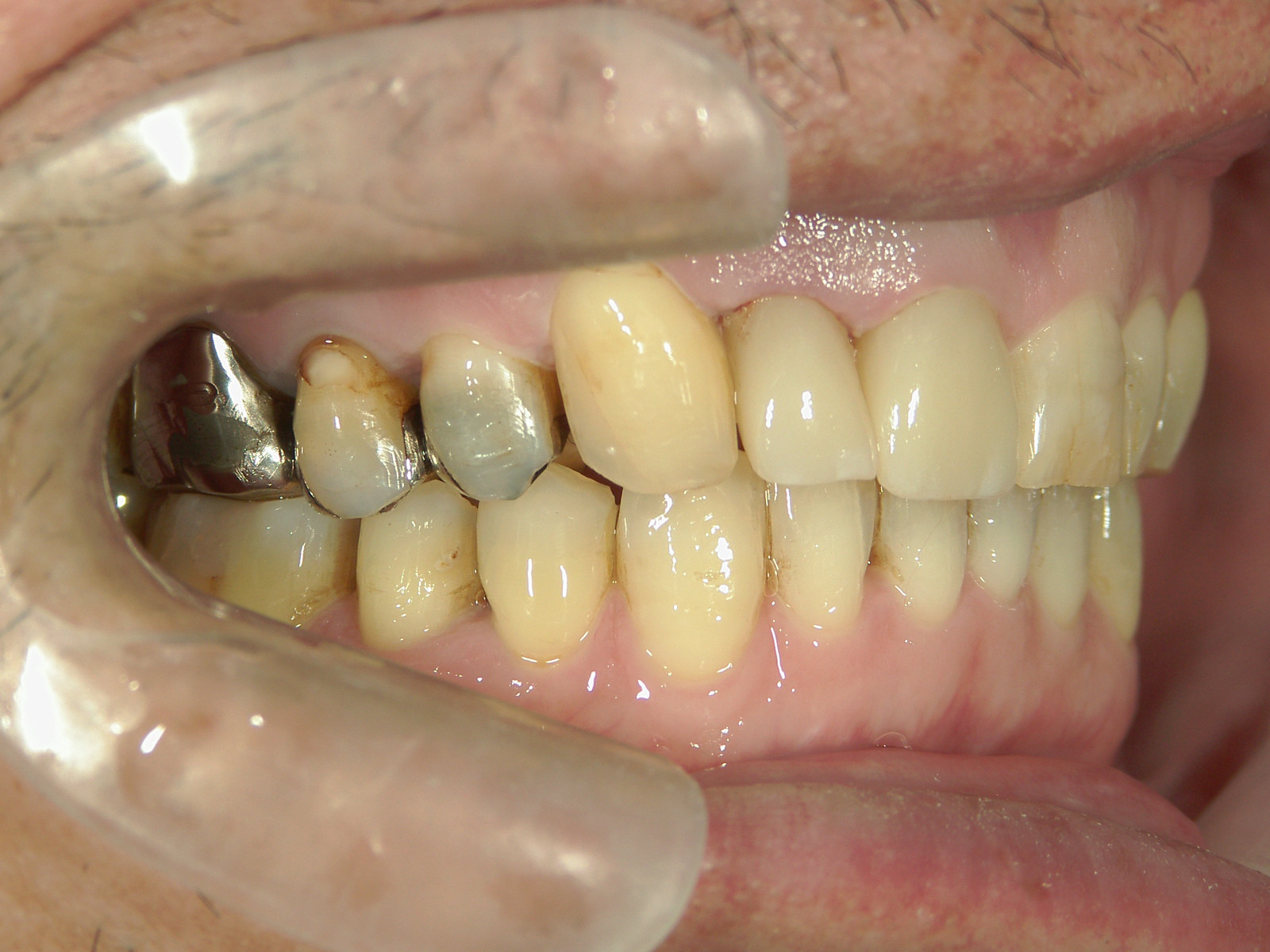 補綴併用症例（1）