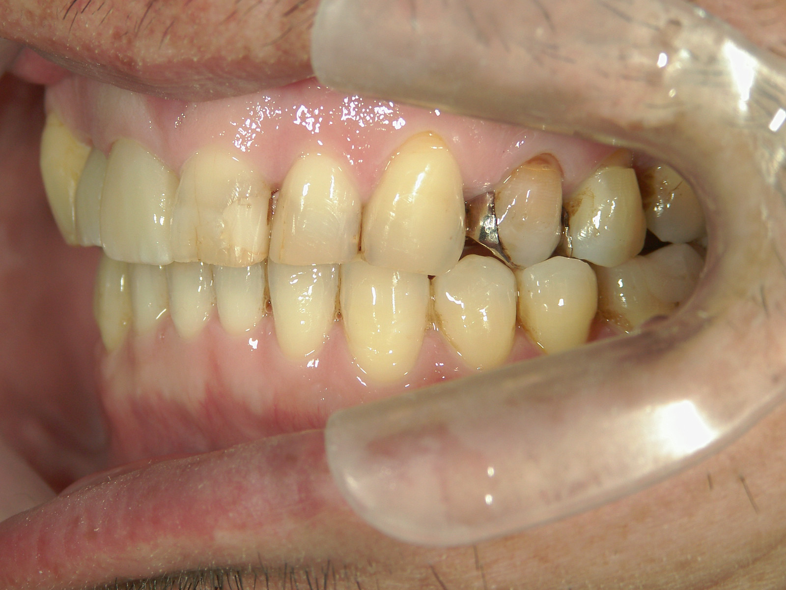 補綴併用症例（1）