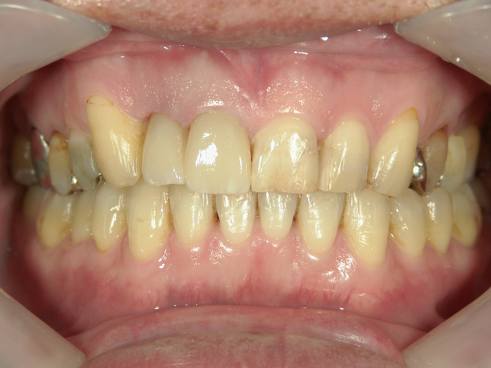 補綴併用症例（1）