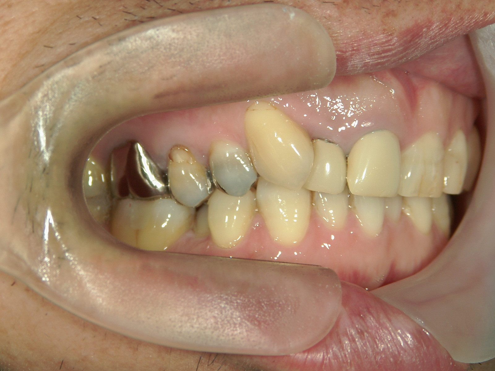 補綴併用症例（1）