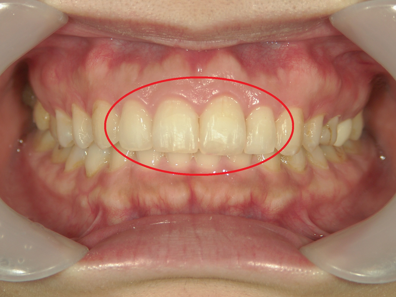 ワンポイント矯正　症例（4）