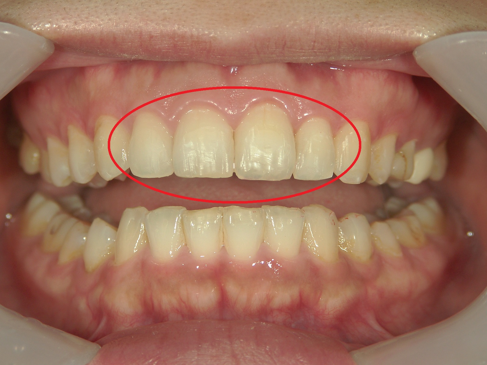 ワンポイント矯正　症例（4）