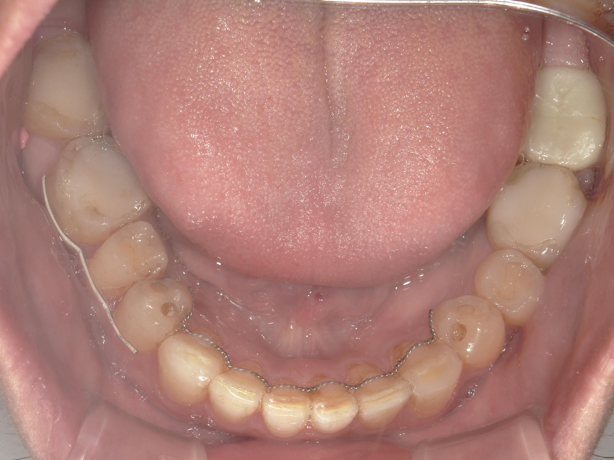 補綴併用症例（1）