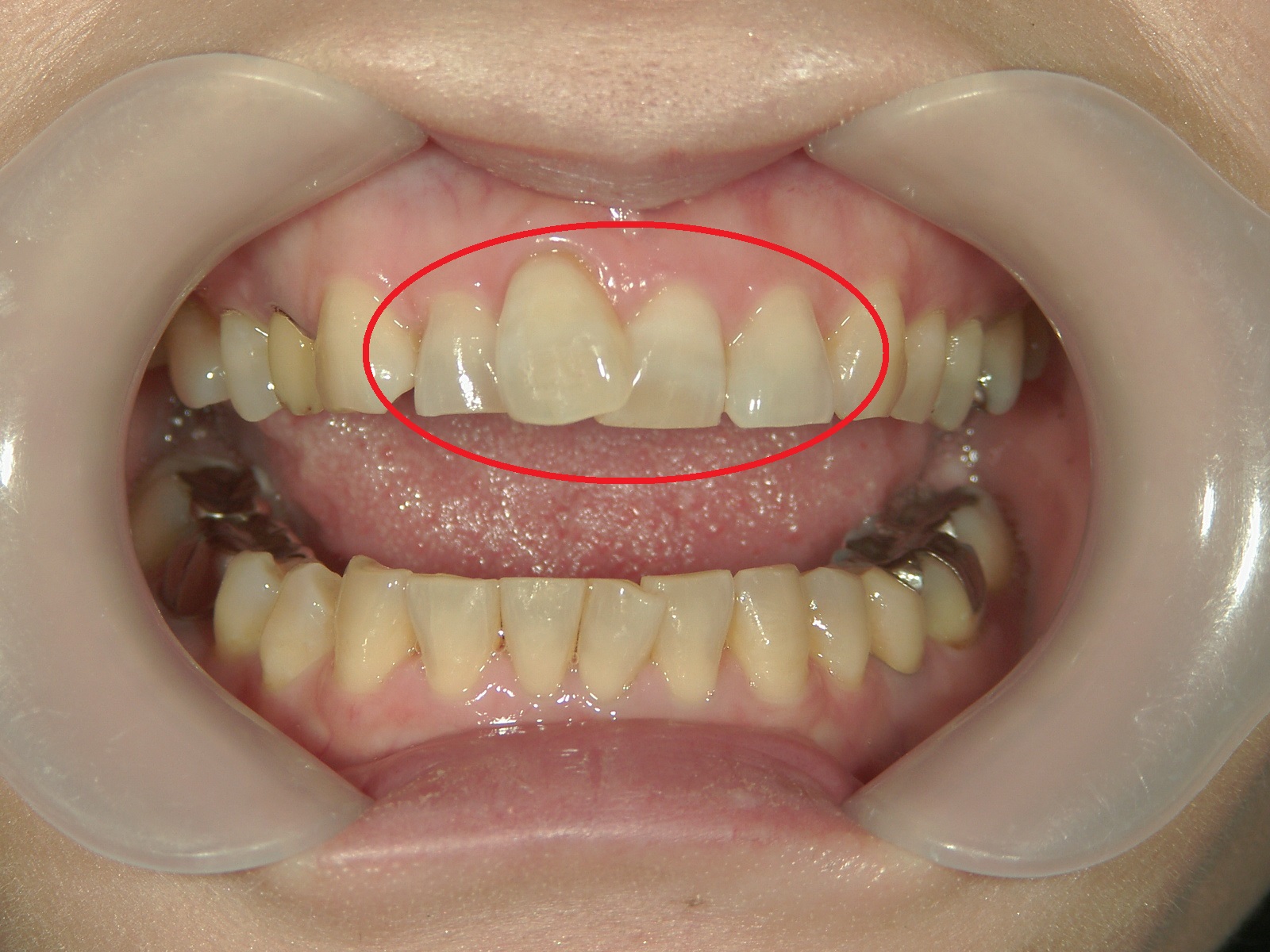 ワンポイント矯正　症例（2）