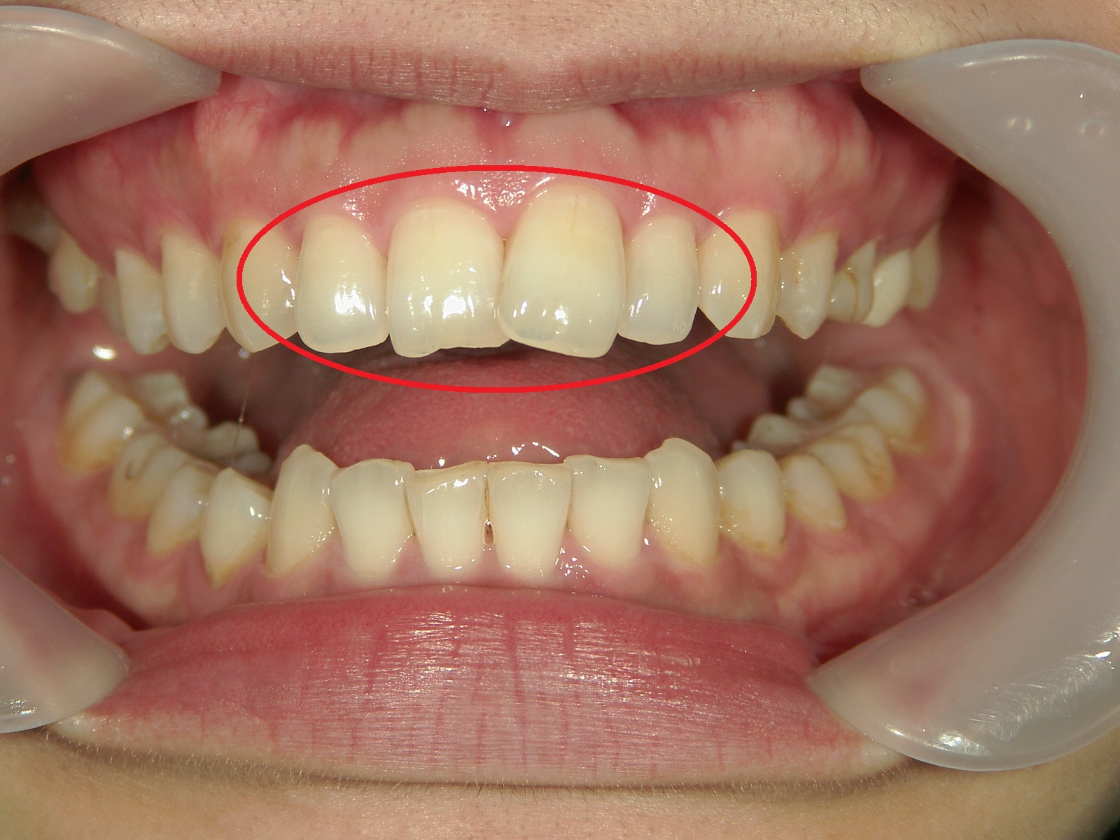 ワンポイント矯正　症例（4）