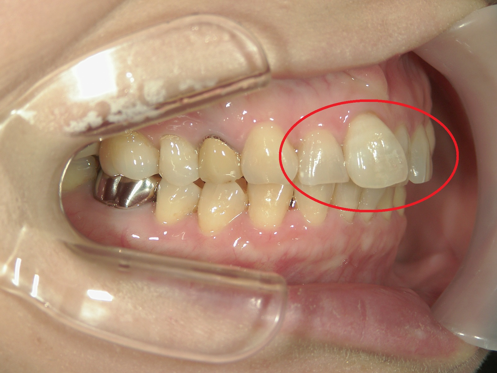 ワンポイント矯正　症例（2）