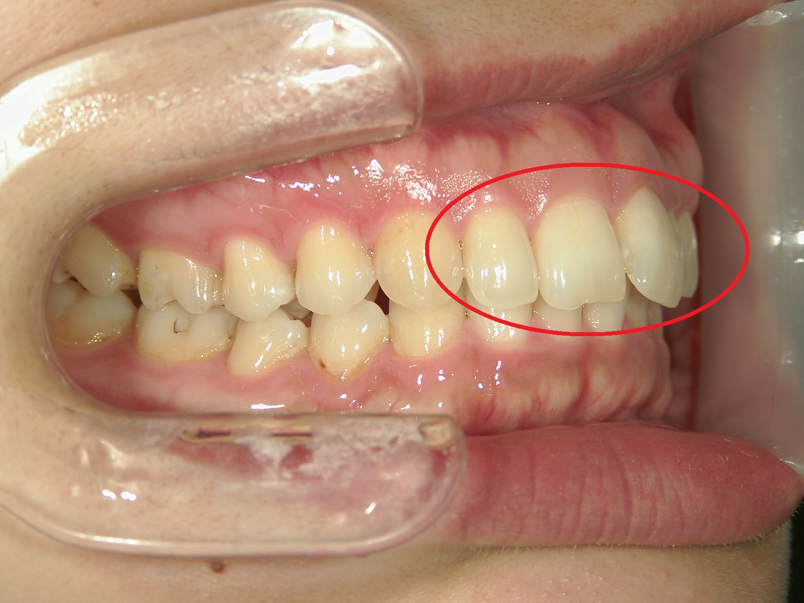 ワンポイント矯正　症例（4）