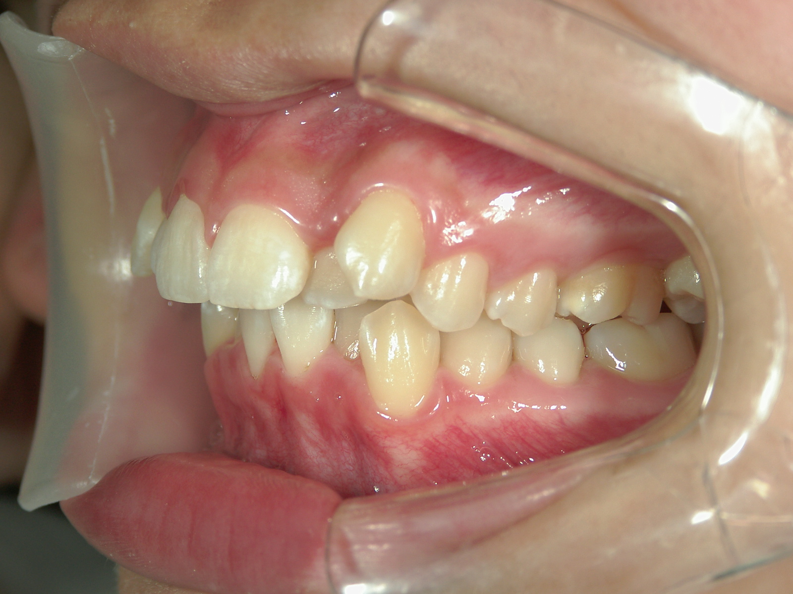 インビザライン矯正　症例（17）