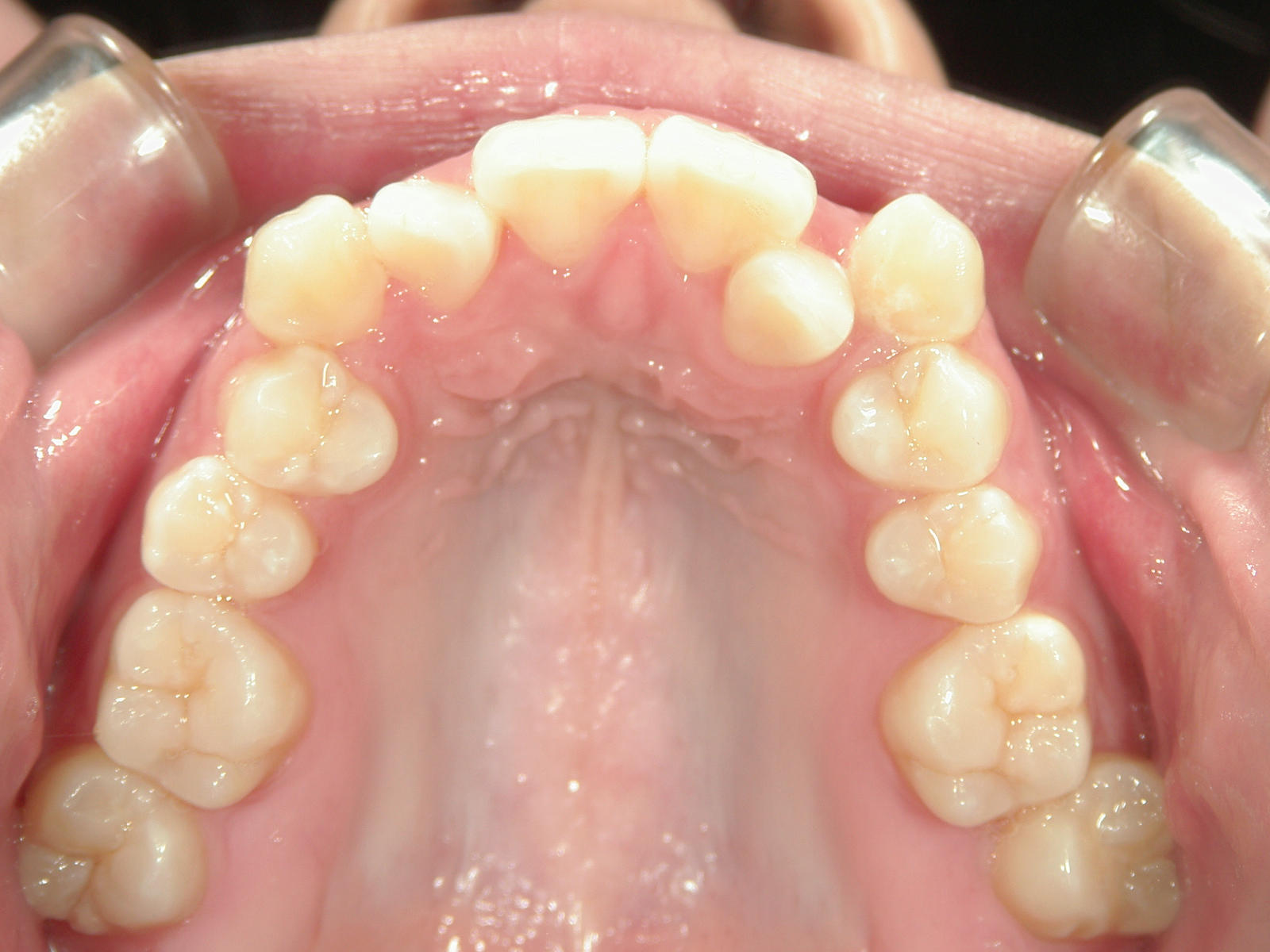 インビザライン矯正　症例（17）