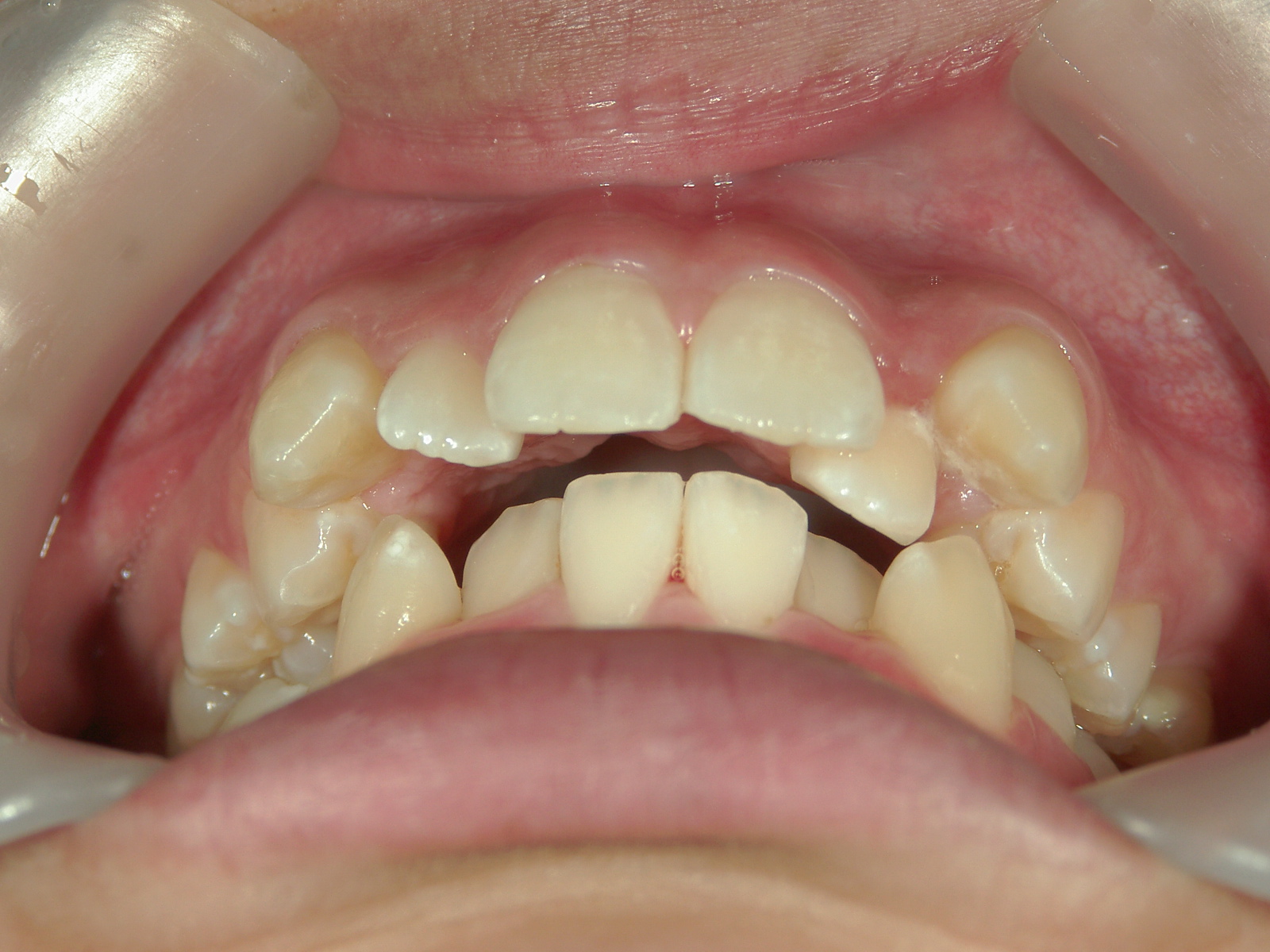 インビザライン矯正　症例（17）