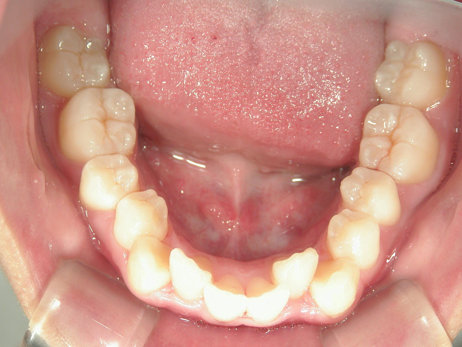 インビザライン矯正　症例（17）