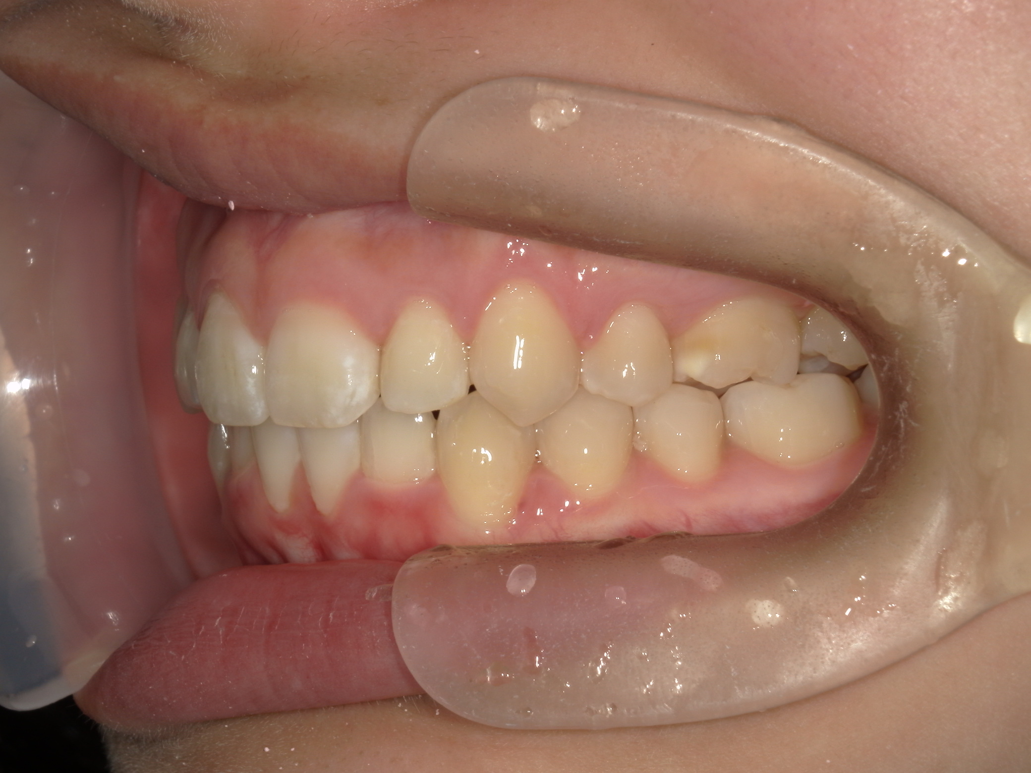 インビザライン矯正　症例（17）