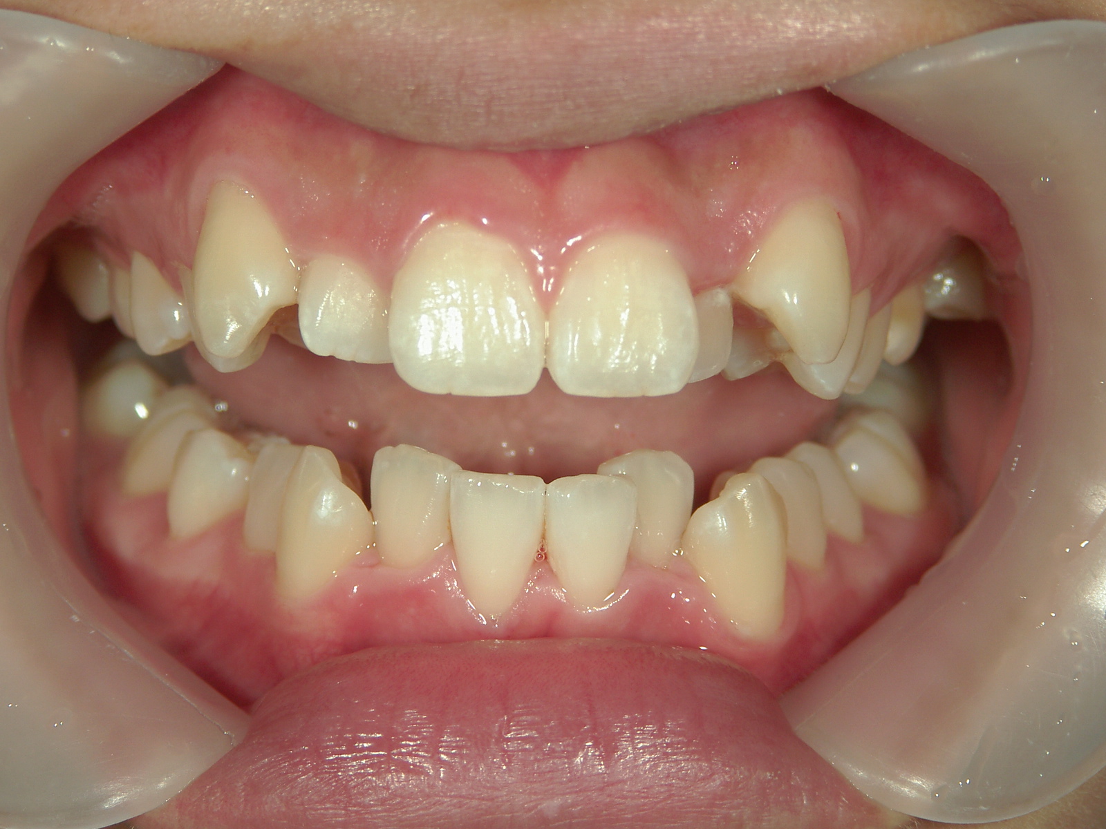 インビザライン矯正　症例（17）